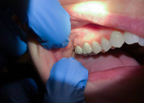 Best Emergency Dentist for Lost Fillings or Crowns in Cochran, GA